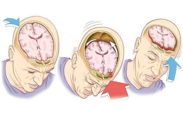 Признаки и симптомы сотрясения головного мозга