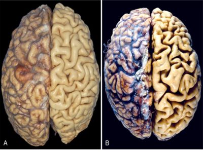 Умеренная атрофия головного мозга у взрослых лечение
