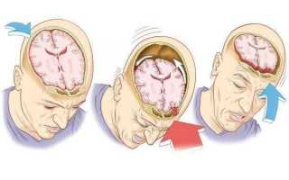 Признаки и симптомы сотрясения головного мозга