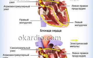 Полная блокада левого желудочка сердца