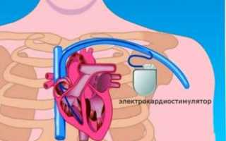 Двухкамерный кардиостимулятор сердца